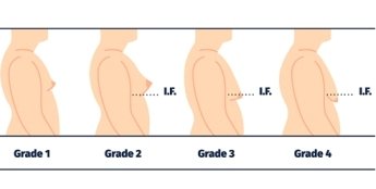 grades of gynecomastia